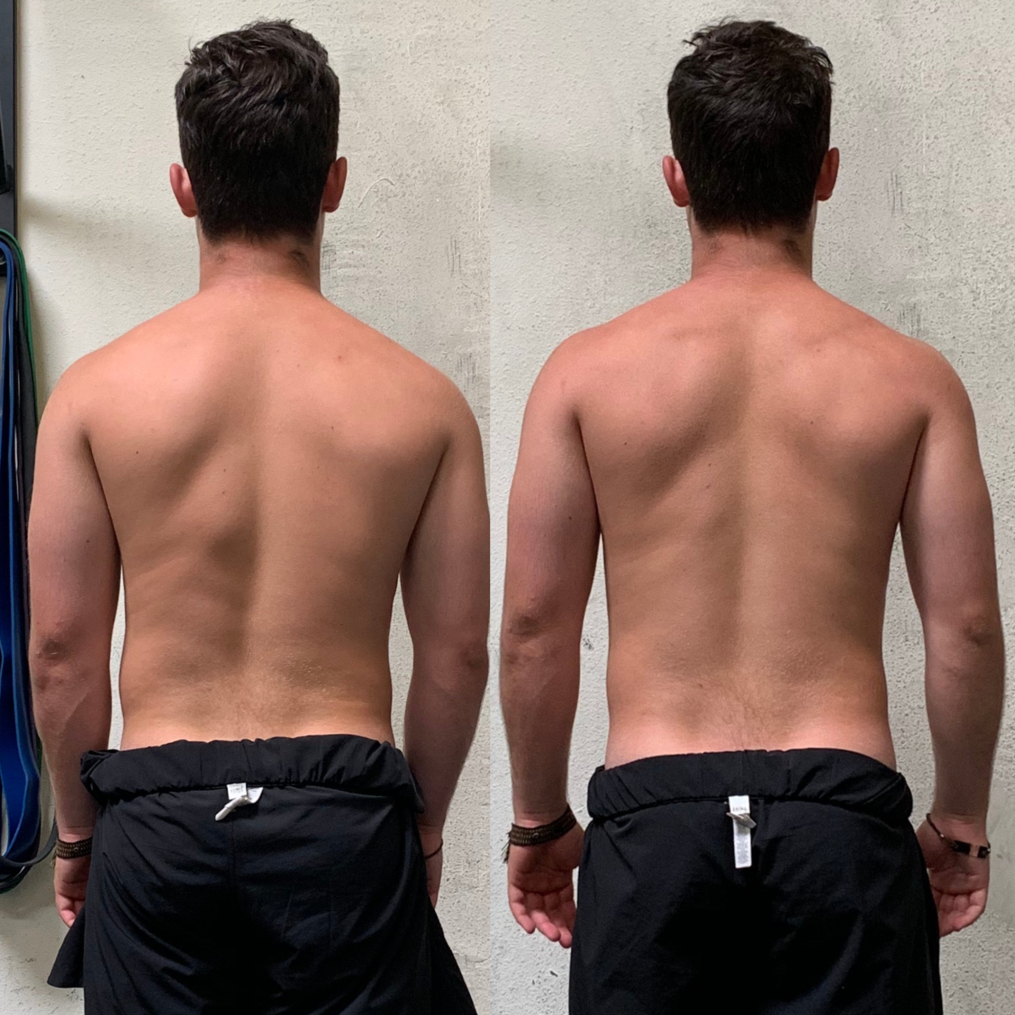 Nick, before and after the mid-back knot resolved