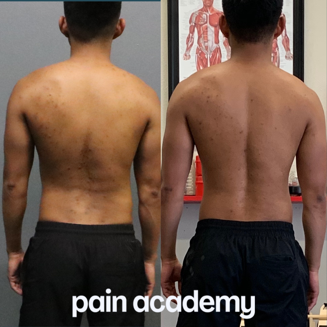 Reggie, before and after the Scoliosis Method