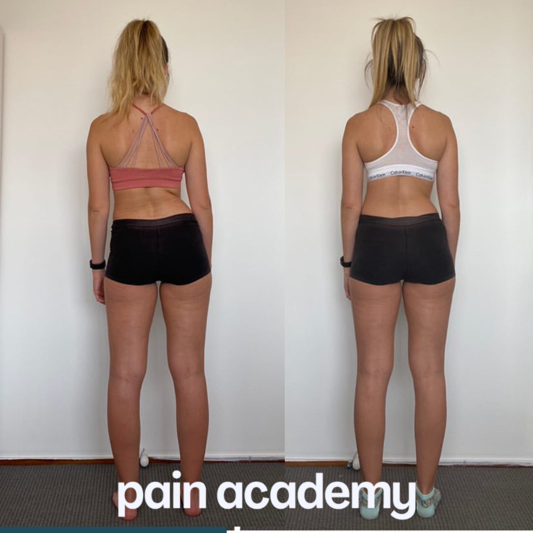 Sam, before and after working with the Scoliosis Method